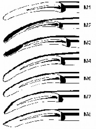 Sonus Optison inserts
