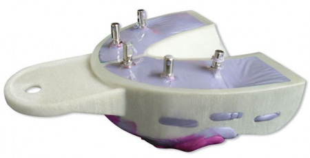 Miratray Implant afdruklepels
