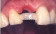 Sigma Dental Ribbond versterkingsband